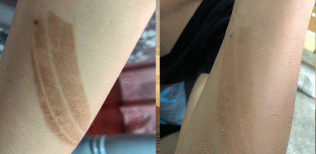 告別燙傷疤痕